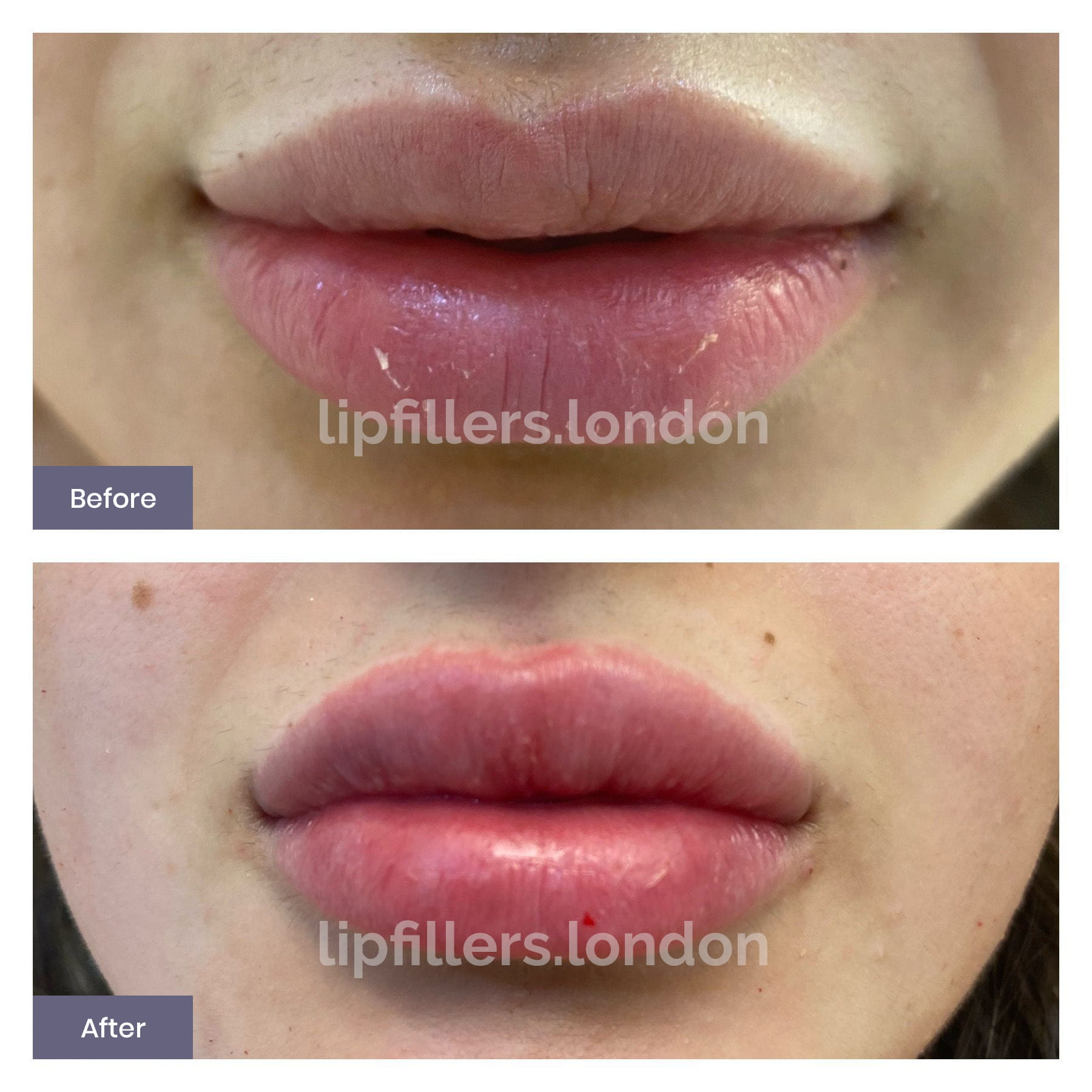 Lip Fillers London - Before and After Results 